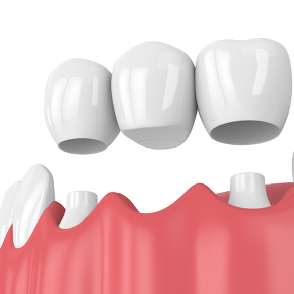 Illustration of a single dental bridge in Altavista, VA for the lower arch