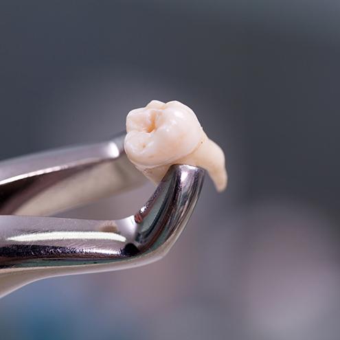 Closeup of extracted tooth held by forceps
