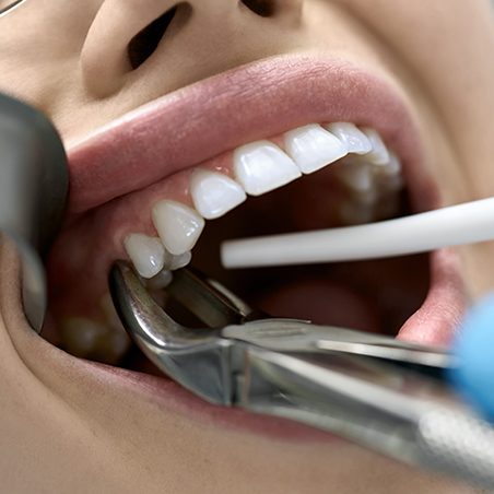 Forceps grasping woman’s tooth to extract it
